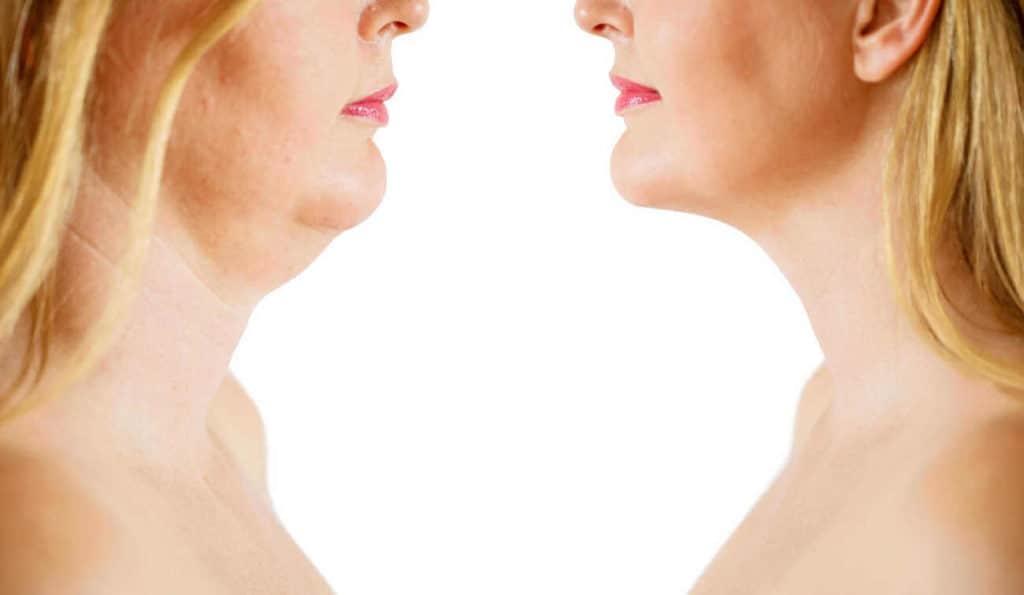 Double Chin treatment Broxbourne before and after results