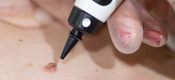 After Skin Tag Removal Broxbourne
