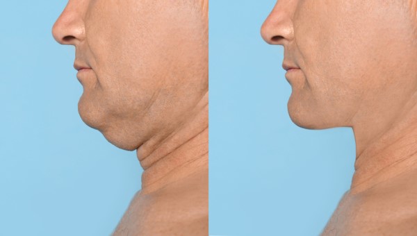 Which Non-Surgical Treatments Work Best for Jowls and Loose Skin Broxbourne?
