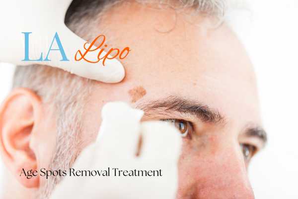 What Are the Most Effective Treatments for Age Spots Broxbourne?