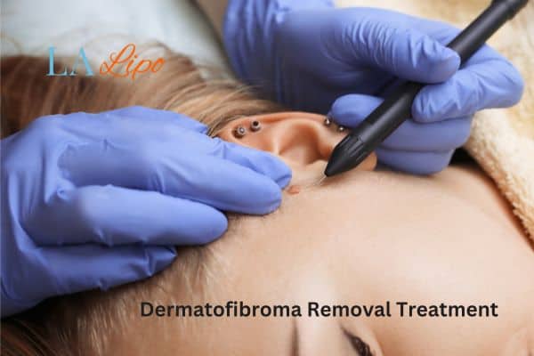 Dermatofibroma Removal Treatment Broxbourne