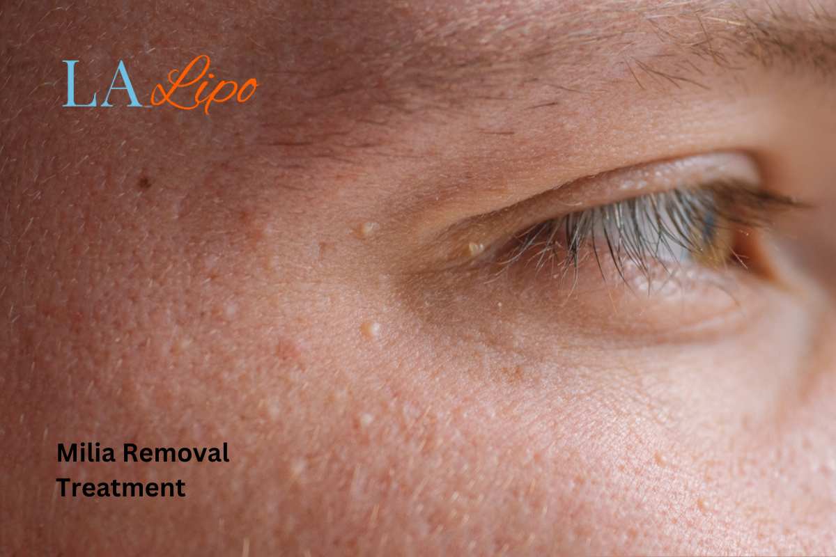 Cryopen Milia Removal: Is It the Easiest and Safest Option Broxbourne?