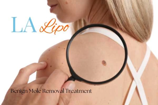 Woman having her inspection of blemish before mole removal Broxbourne