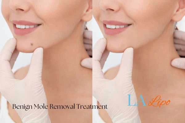 Before and after mole removal Broxbourne treatment