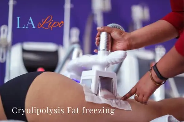 women getting fat freezing Broxbourne