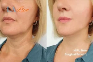 hi-fu for wrinkles Broxbourne before and after results