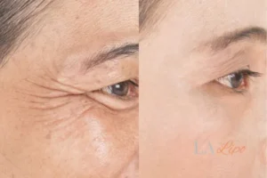 Before and after results of woman - HI-fu wrinkles reduction treatment Broxbourne