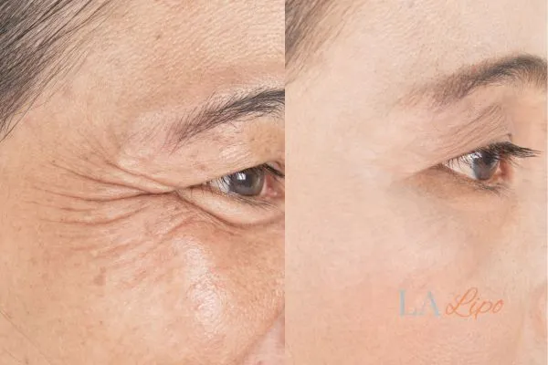 Before and after results of woman - HI-fu wrinkles reduction treatment Broxbourne