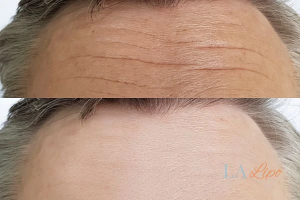 results of HIFU Broxbourne on mans forehead to help reduce lines and wrinkles