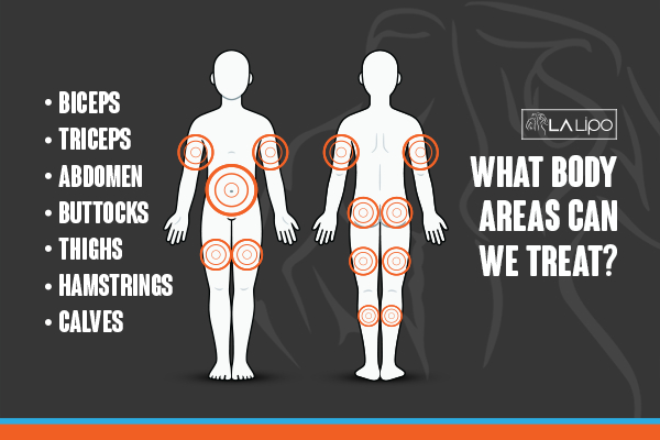 Graphic to show areas you can have LA-EMS Body Sculpting Broxbourne treatment.