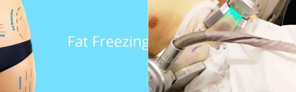 Fat freezing Broxbourne on multiple areas of the body