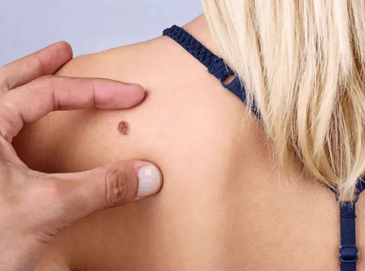 woman having mole removal Broxbourne consultation before treatment.