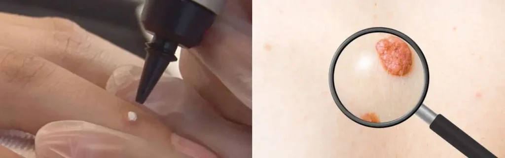Cryopen for mole removal Broxbourne - speak to our team today!