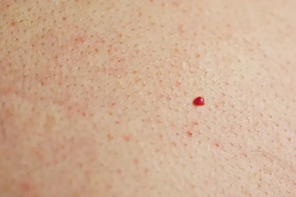 close up of a cherry angioma Broxbourne