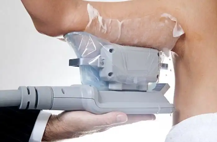 Picture of fat freezing Broxbourne on the upper arms.