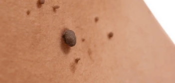 image of a skin tag Broxbourne