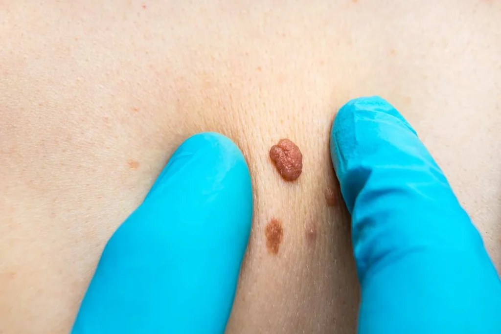 Consultant examining a skin tag Broxbourne