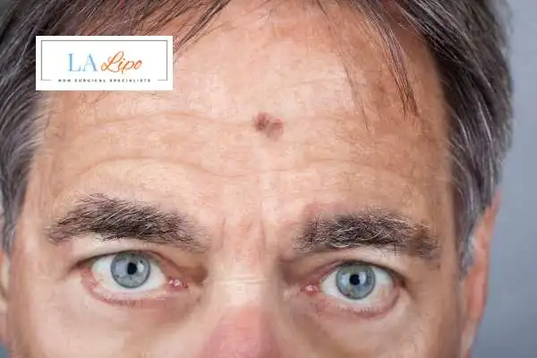 Solar Lentigo Removal Broxbourne image of man with mark on his forehead