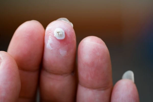 wart on person finger - cryotherapy to treat from LA LIPO Broxbourne