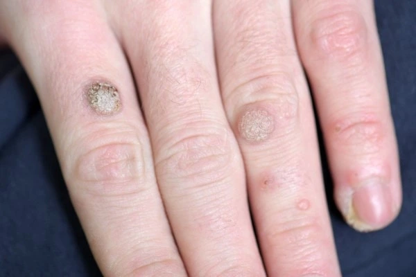 photo of warts on person hand - see wart removal Broxbourne from LA LIPO