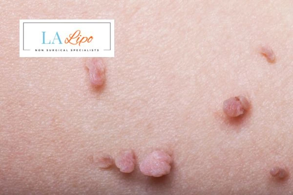 Does cryopen skin tag removal Broxbourne hurt? Find out now call our team today!