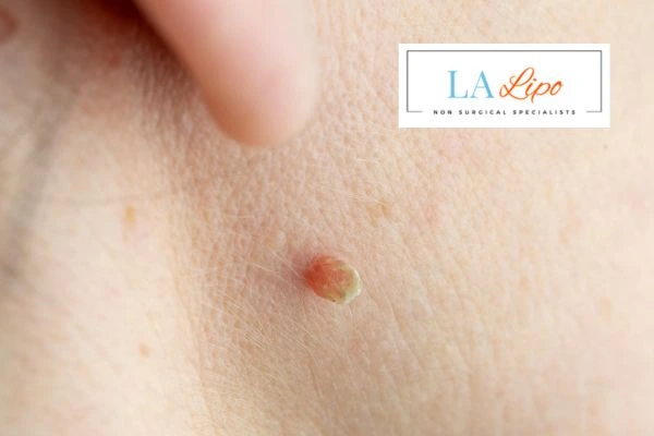 Book skin tag removal Broxbourne today speak to our team now!