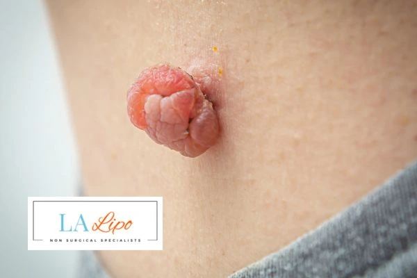 Interested in skin tag removal Broxbourne? Concerned about the pain? Find out more today!