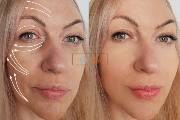 Morpheus 8 results Broxbourne face lift.