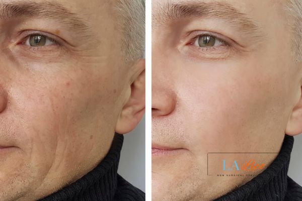 See the amazing results of Morpheus8 Treatment Broxbourne!