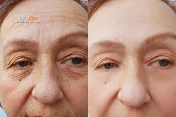 The powerful benefits of Morpheus8 Treatment Broxbourne - Call Our team today!
