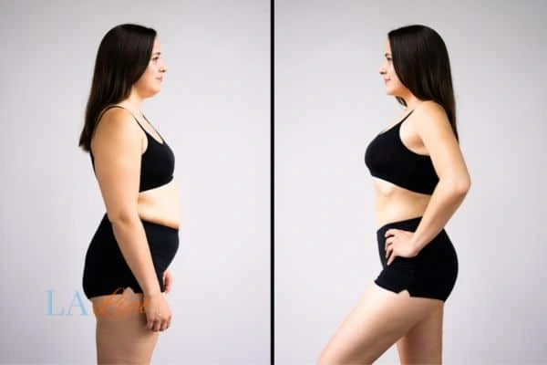 Picture of womans before and after using LA-EMS body sculpting to improve her core strength Broxbourne