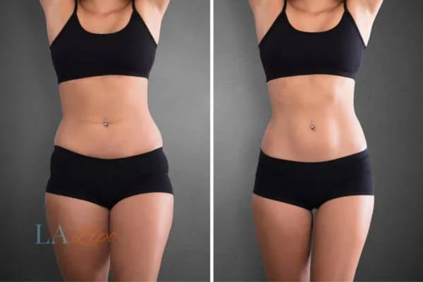 before and after results of non-surgical treatment to help a woman's body image and mental health Broxbourne