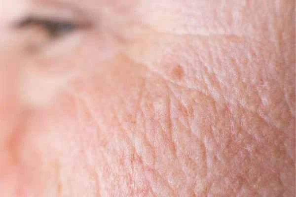 close up picture of a woman's face showing an age spot Broxbourne