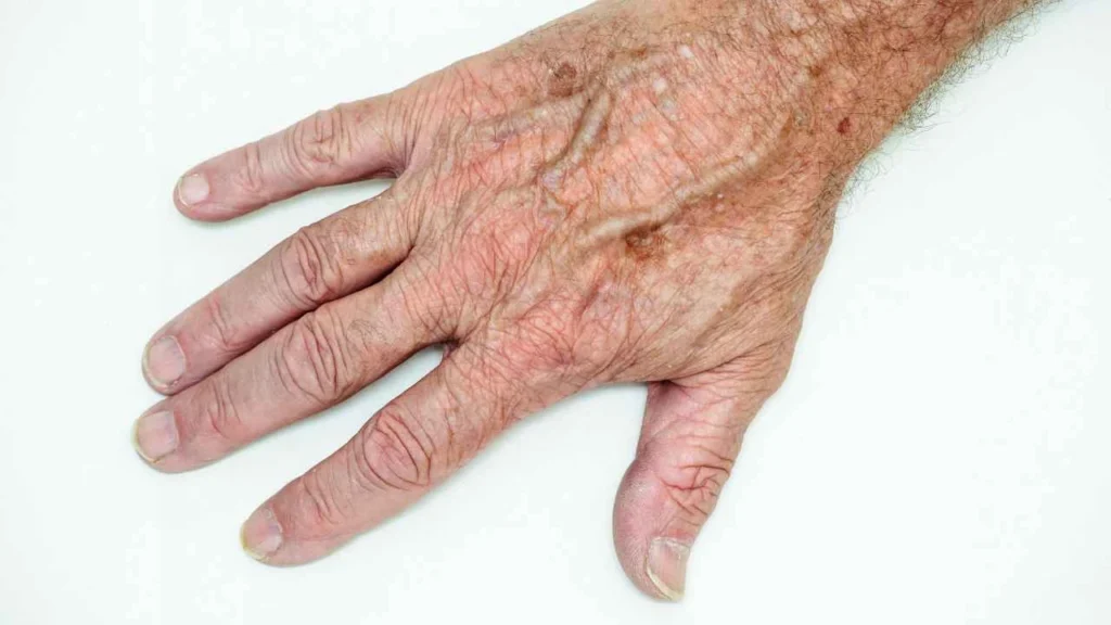 Male hand showing age spot Broxbourne