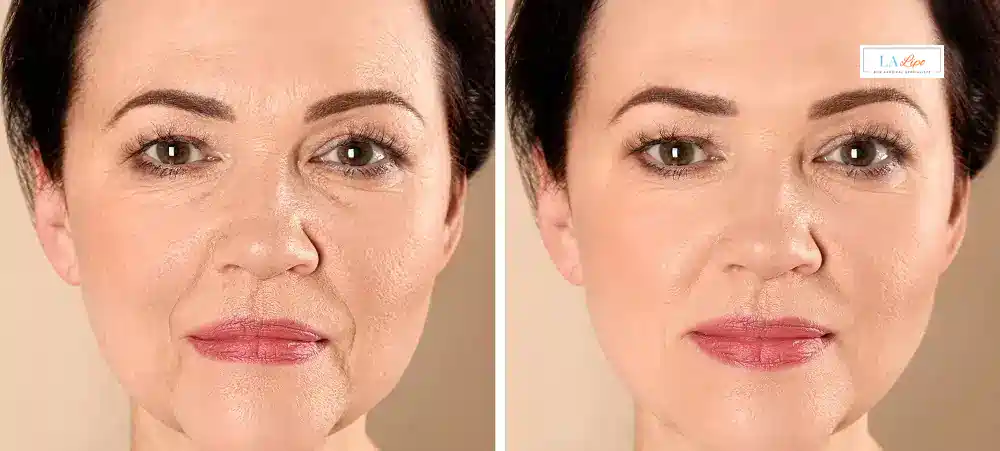 How Long Does It Take to See Results and How Long Do They Last Broxbourne?