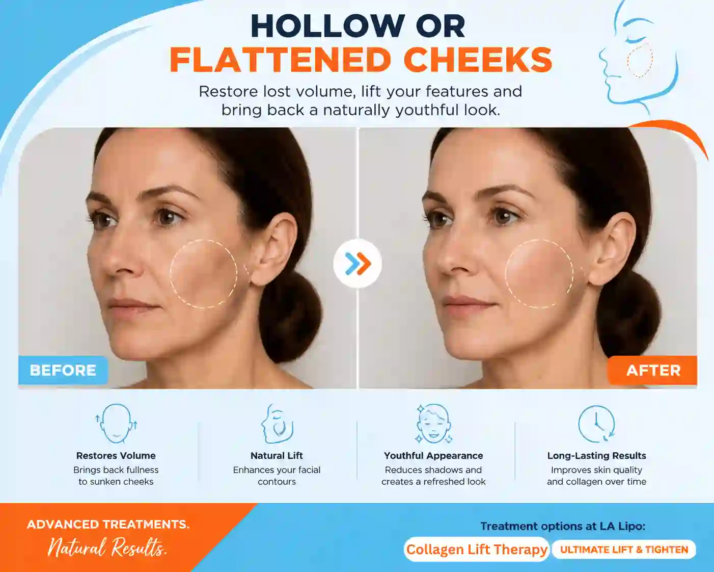 Sign #4: Hollow or Flattened Cheeks Broxbourne